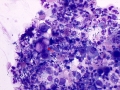 Urothelial carcinoma & septic inflammation (dog)