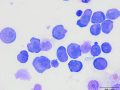 Lymphoma