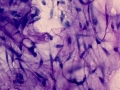 Myxoid tumor