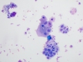 Urothelial atypia