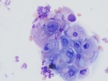 Urothelial atypia