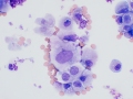 Urothelial atypia