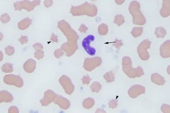Blood artifacts