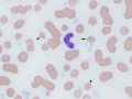 "False" band & echinocytes