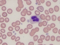 "False" band neutrophil