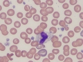 "False" band neutrophil