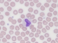 "False" metamyelocyte