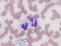 Storage neutrophil changes & platelet clumps
