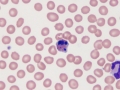 Apoptotic WBC