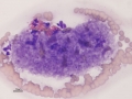 Platelet clump