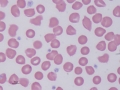 Lipemia
