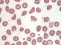 Lipemia