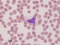 Smudged cells & echinocytes