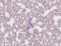 Smudged cells & echinocytes
