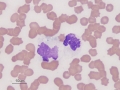 "Smudgocytes"