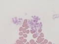 Platelet clumps