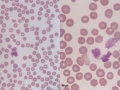 Smudged leukocyte