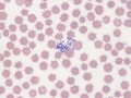 Stain precipitate & echinocytes
