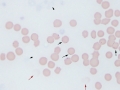 Water artifact, degranulated platelets, lysed RBCs