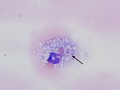 Hemophagocytosis