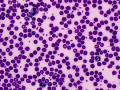 Over-stained smear