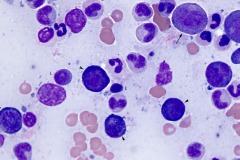 Non-neoplastic