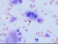 Dysplastic megakaryocyte