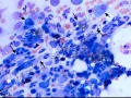 Pure red cell aplasia (PRCA, dog)