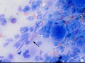 Presumptive fibrosis