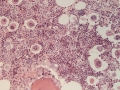 Megakaryocytic hyperplasia (H&E)