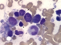 Suspect myelotoxin