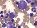 Suspect myelotoxin