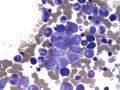 Suspect myelotoxin