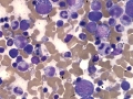 Suspect myelotoxin