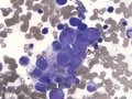 Suspect myelotoxin