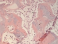 Immature bone (H&E)