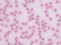 Regenerative anemia due to Babesia (reindeer)