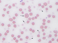 Copper poisoning (sheep)