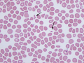Schistocytes (kid)