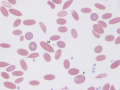 Macrocyte & polychromatophil