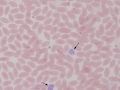 Large platelet