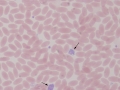 Large platelet
