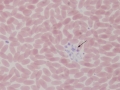 Platelet clump