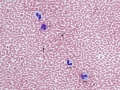Toxic bands & Basophil