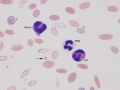 Toxic seg & eosinophil & monocyte