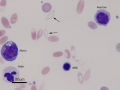 Monocyte & nRBC & reactive lymphocyte