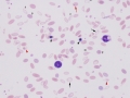 Monocytes & nRBC & hypochromasia