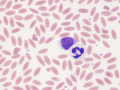 Neutrophil & reactive lymphocyte
