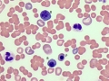 IMHA (nRBC)