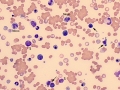 IMHA (nRBC vs lymph)